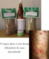 LICHEN PLANUS KIT (4 PRODUCTS)